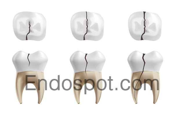 Is it Really a Vertical Root Fracture?