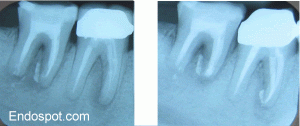 Reimplantation healing