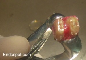 Reimplantation Endodontics