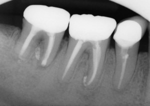 The three year review PA shows good healing of the apical lucencies. This simple and inexpensive treatment has allowed this patient to keep their tooth in function in the short term. I will keep recalling the patient. 