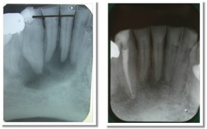 Images showing importance of pulp testing