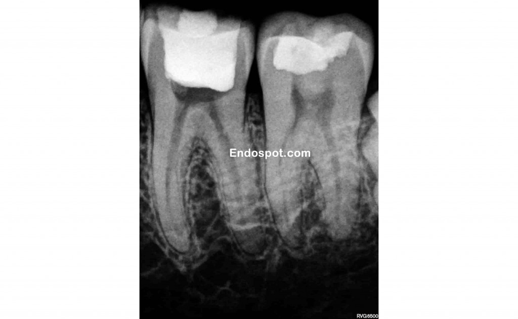 Poor endodontic access