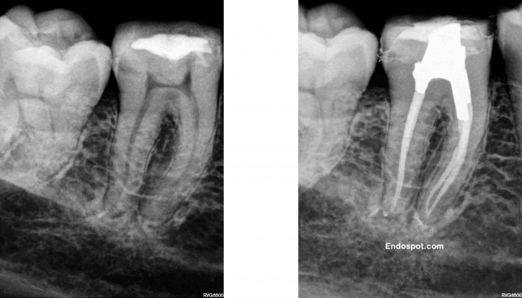 Conservative endodontic access in lower molar